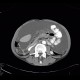Carcinomatous peritonitis, mixed tumour of appendix, carcinoid and adenocarcinoma: CT - Computed tomography